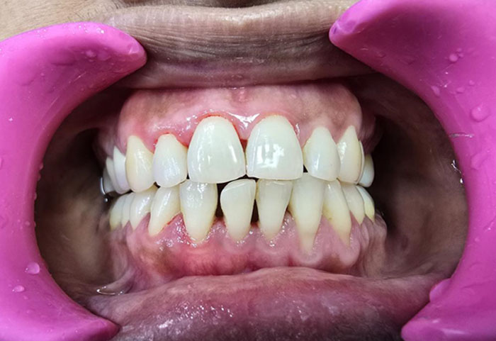 100% deposit removal after GBT