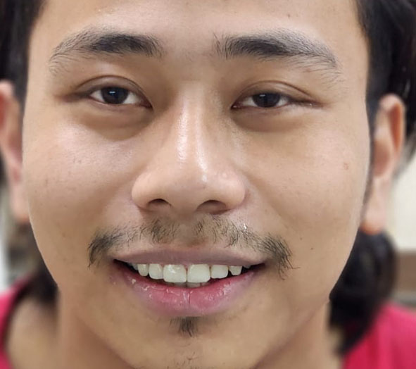 After Smile correction