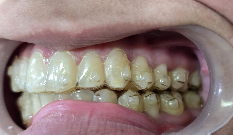 Invisible aligners