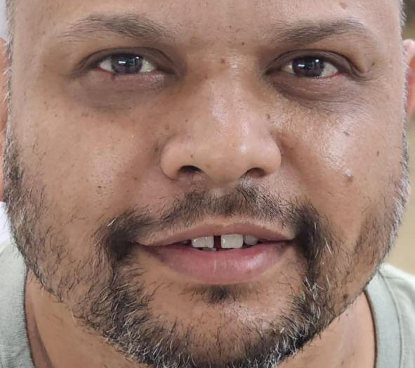 Before Dental Bonding