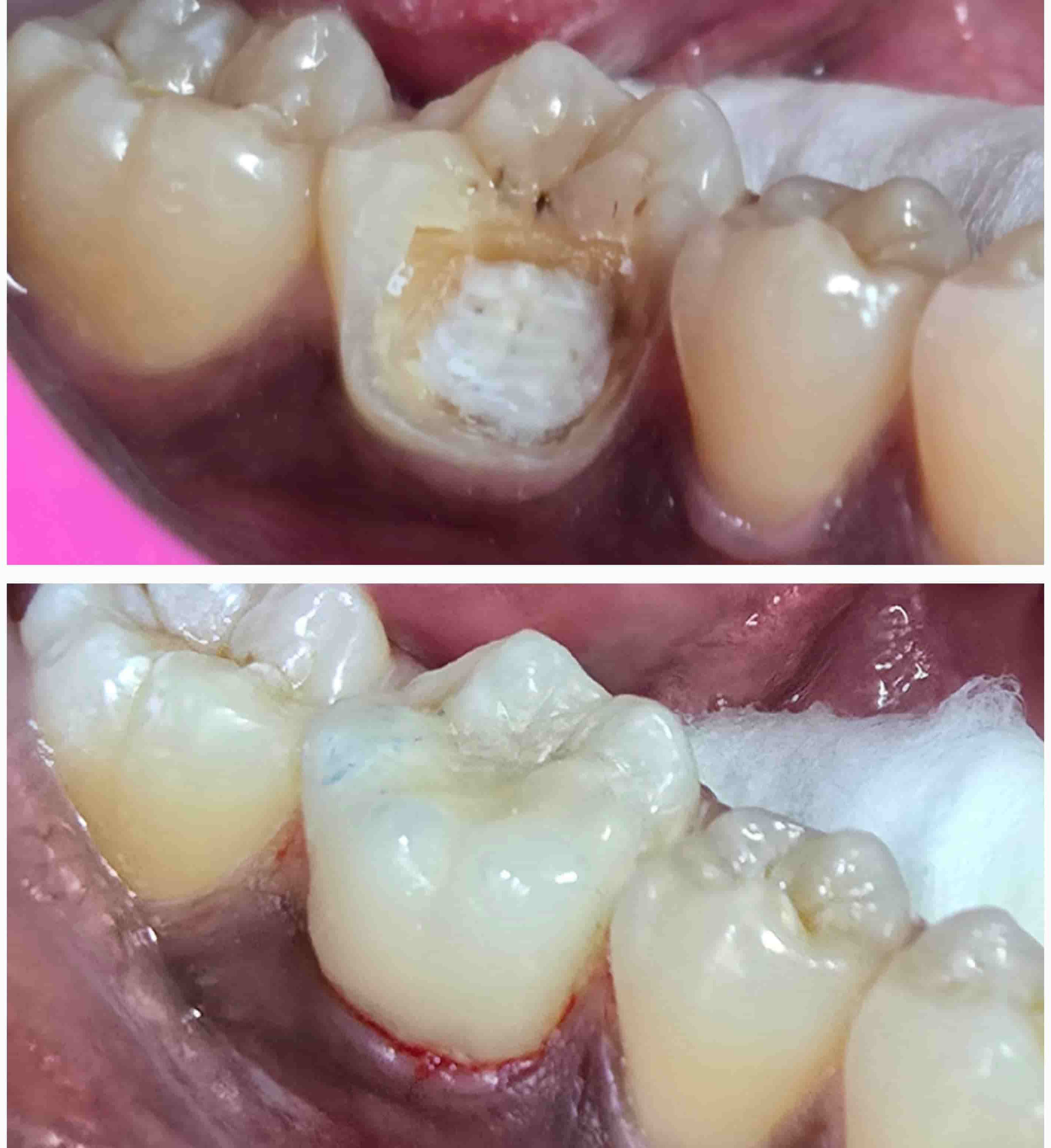 Before and after image of Inlay