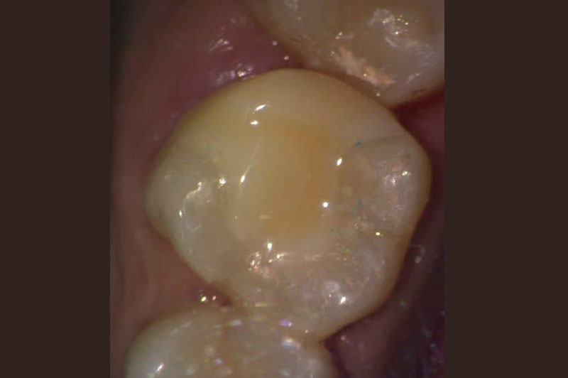 Fixed to teeth and finished