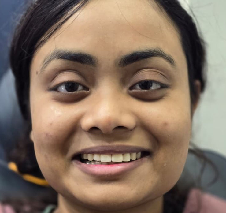 Aligned smile with Braces