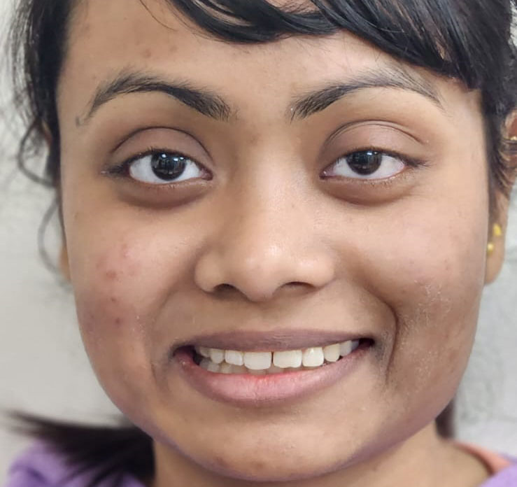 Uneven smile correction