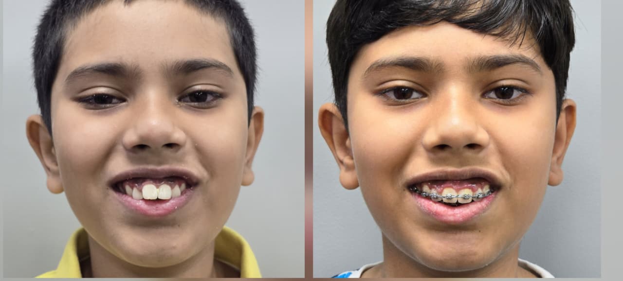 Braces for children in Delhi