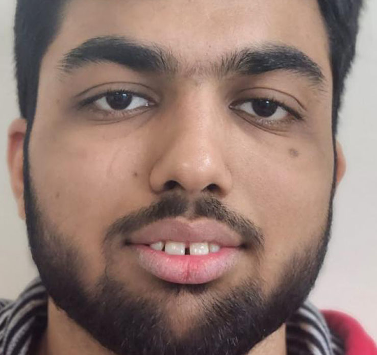 Front teeth gap and teeth protrusion