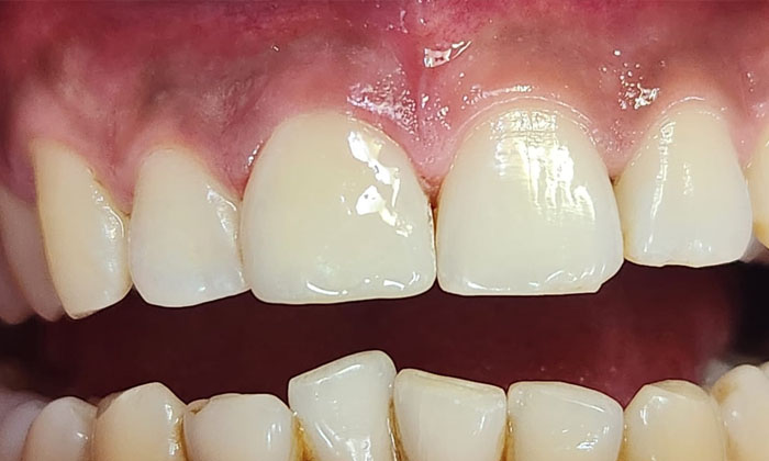 Chipping repaired with Veneer