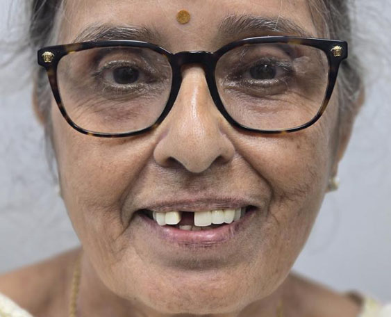 Single missing tooth