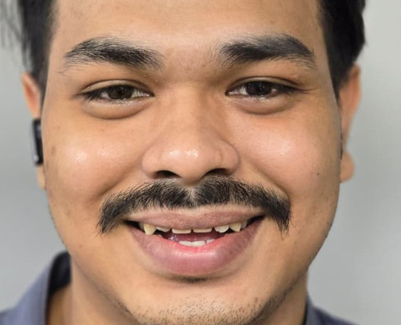 Two dental implants for front teeth