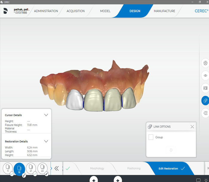 CAD/CAM Veneers