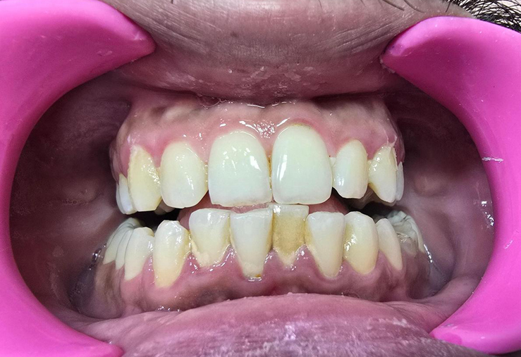 Teeth deposit