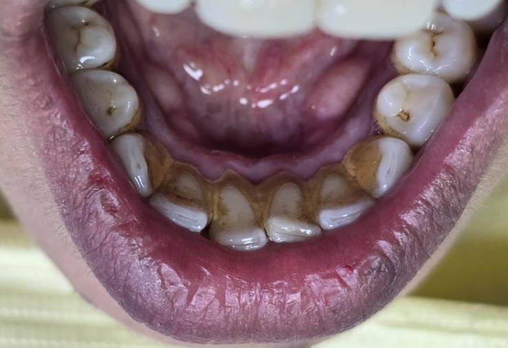 Heavy deposit on backside of teeth