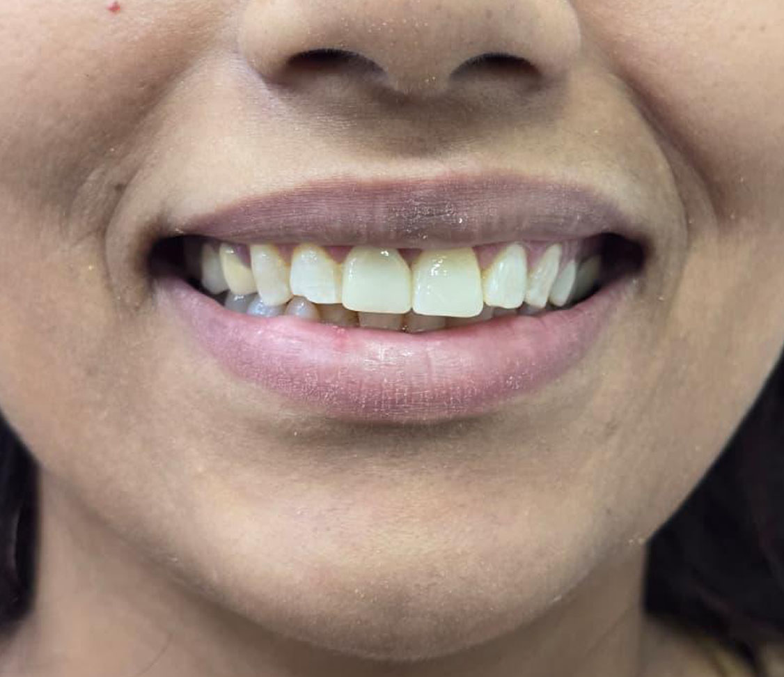 After tooth contouring