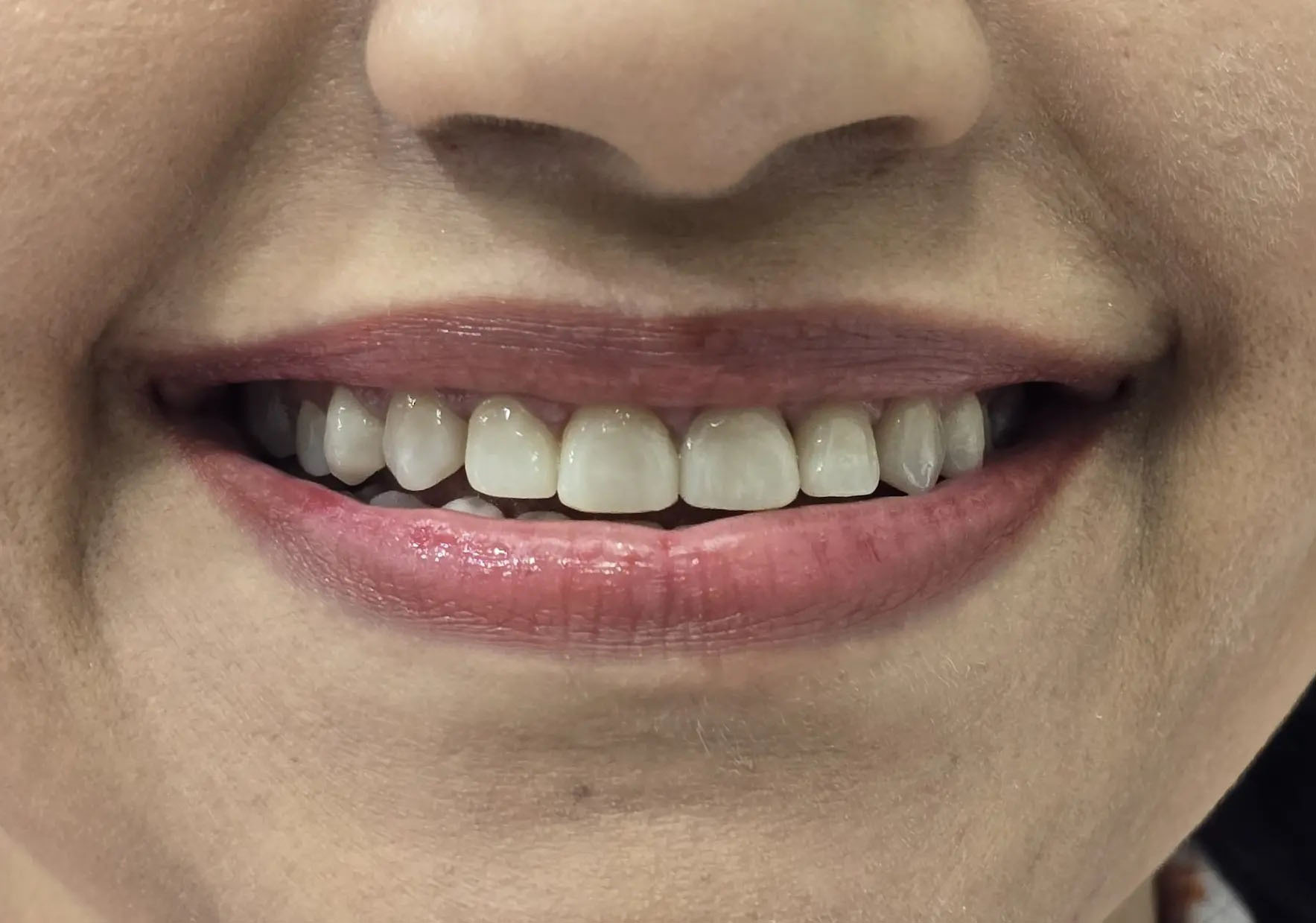 Teeth reshaping