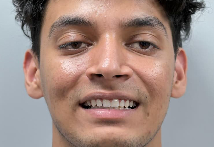 Gaps closed with Invisalign