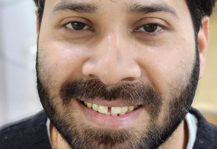 Case of excessive Gaps