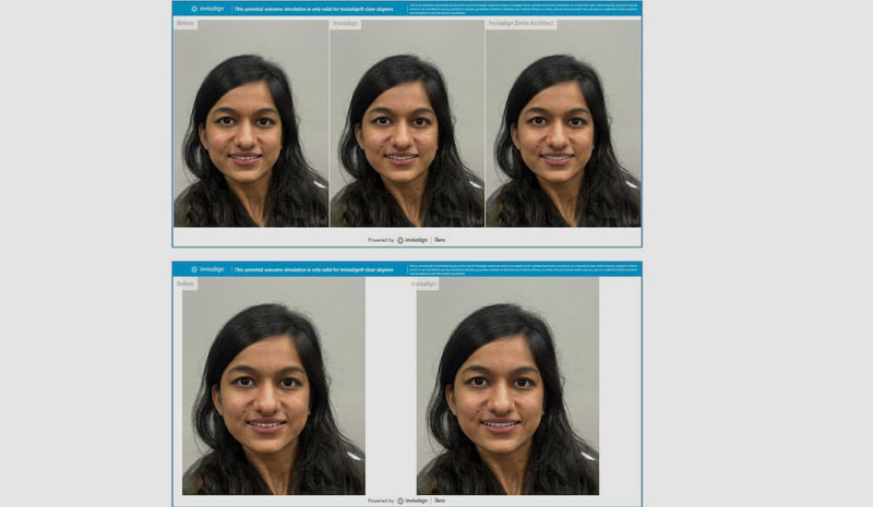 3D simulation with invisalign