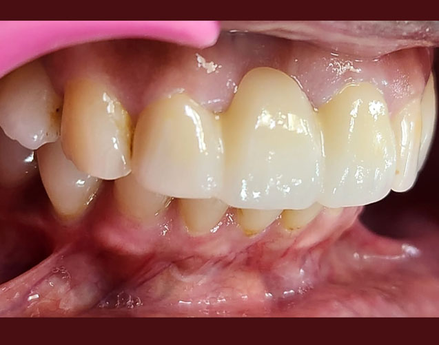 Front teeth bridge