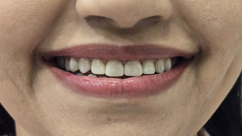 quick correction with reshaping