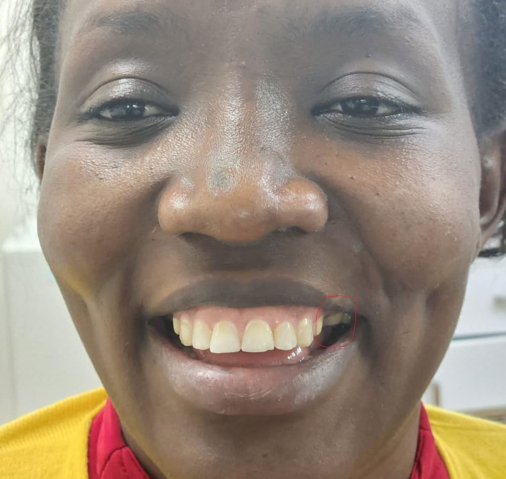 International patient for Bridge