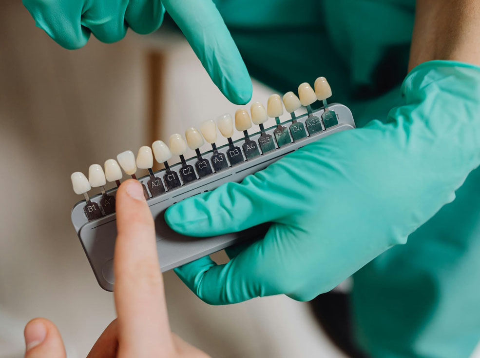 Veneers for front teeth in Delhi