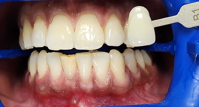 Stain reduction after whitening