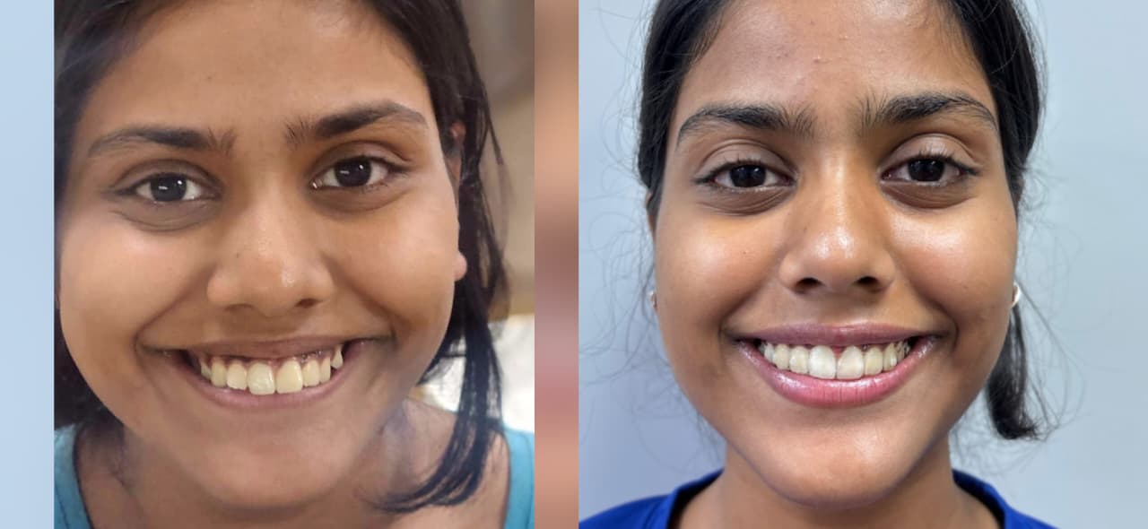 Teeth alignment with Braces