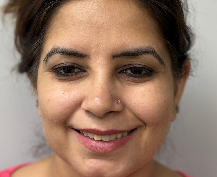 Teeth alignment with invisalign