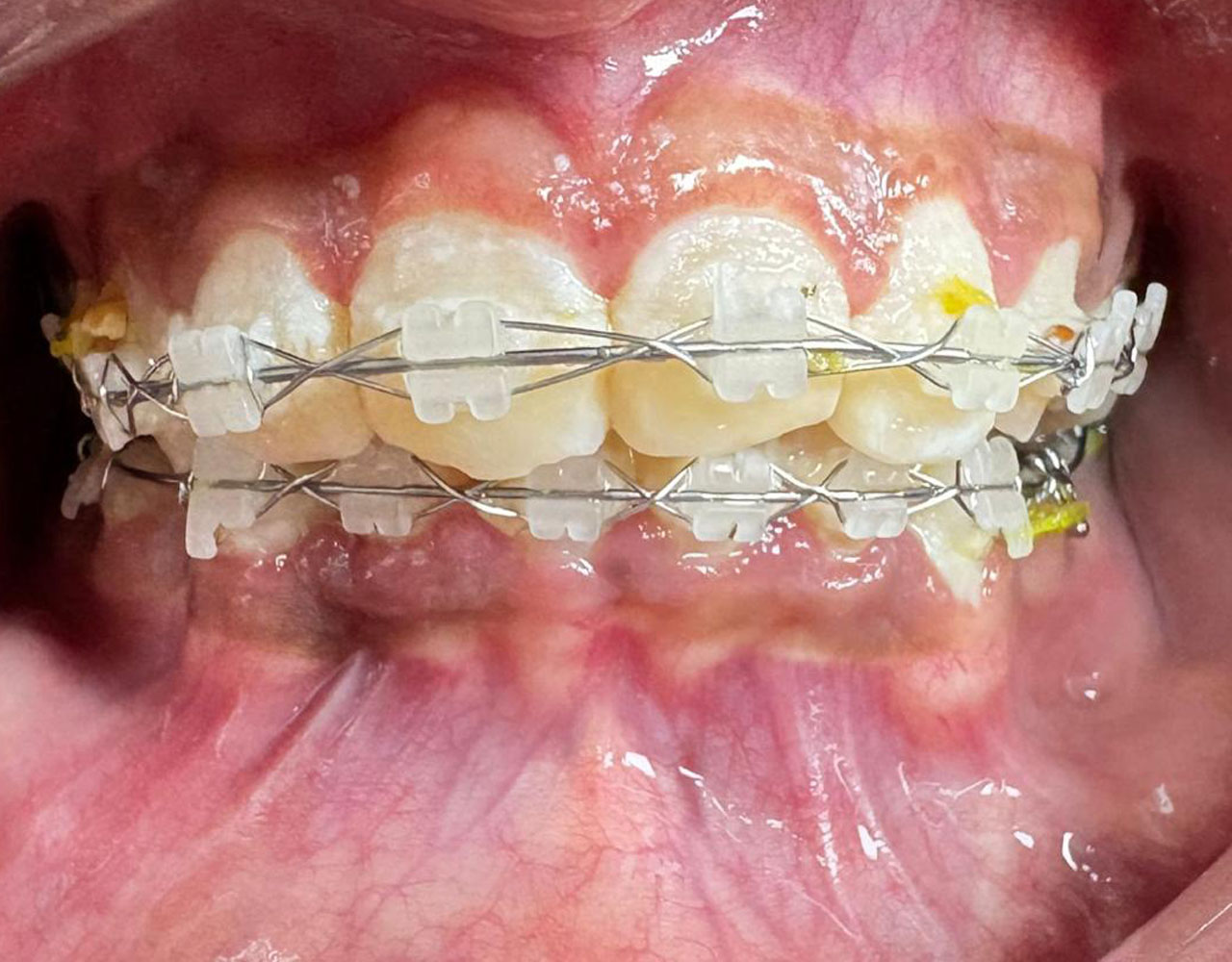 Teeth Colored Braces