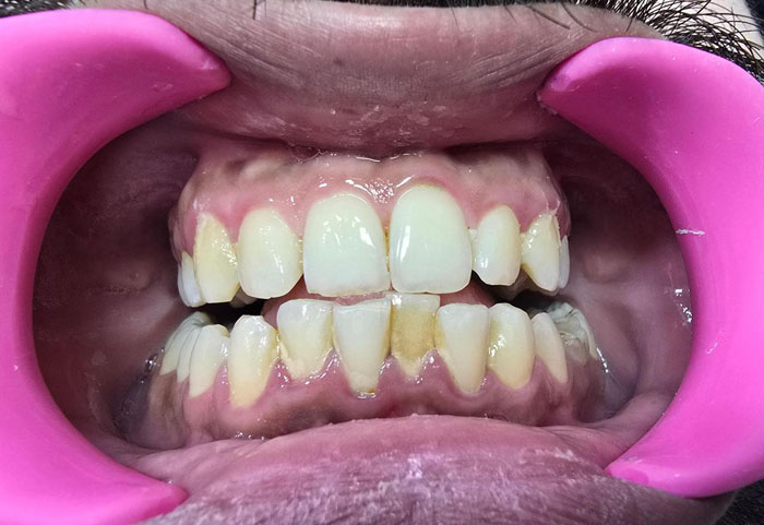Teeth Deposits before GBT