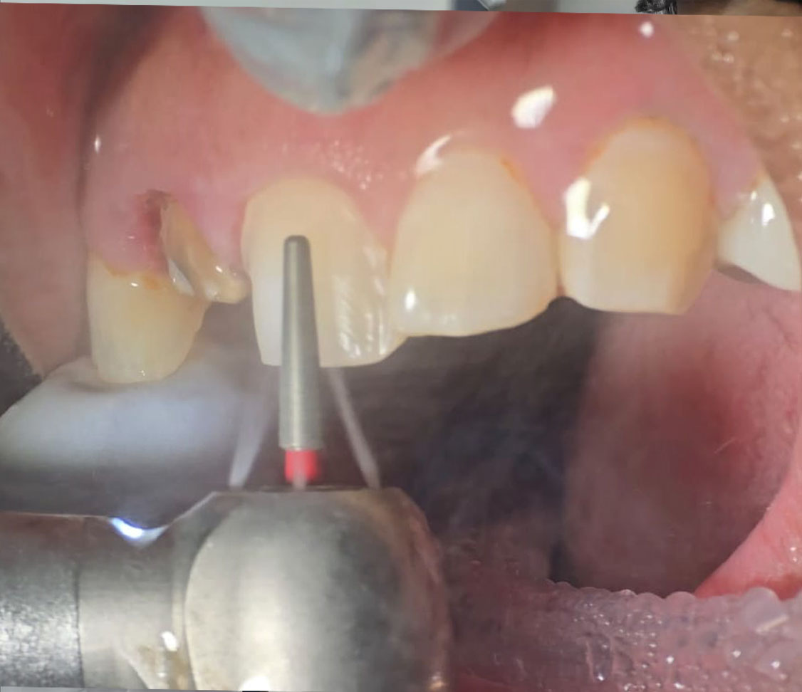 Tooth reshaping