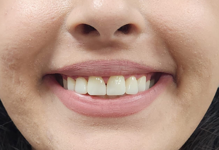 Smile correction with EMax