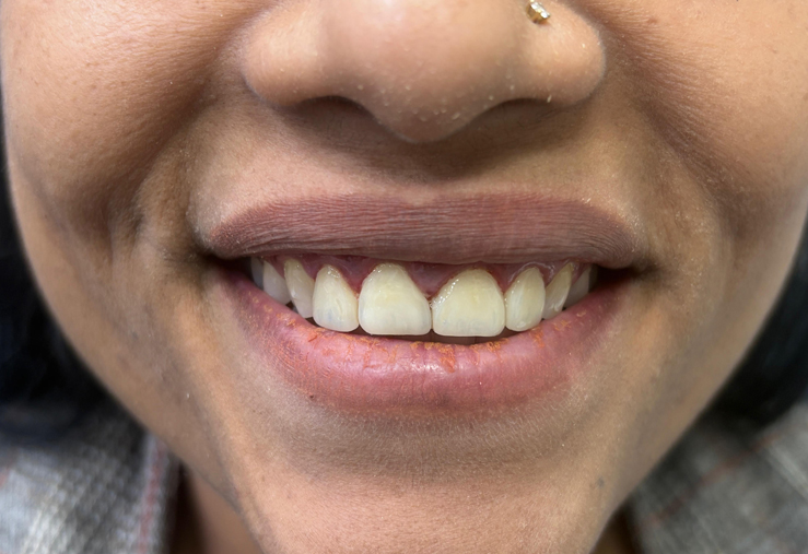 Smile enhancement with Esthetic dentistry