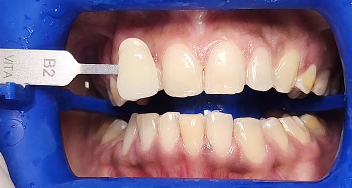 Whiter teeth after Zoom